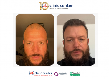 Clinic Center Hair Transplant