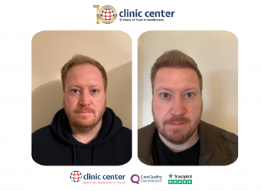 Clinic Center Hair Transplant